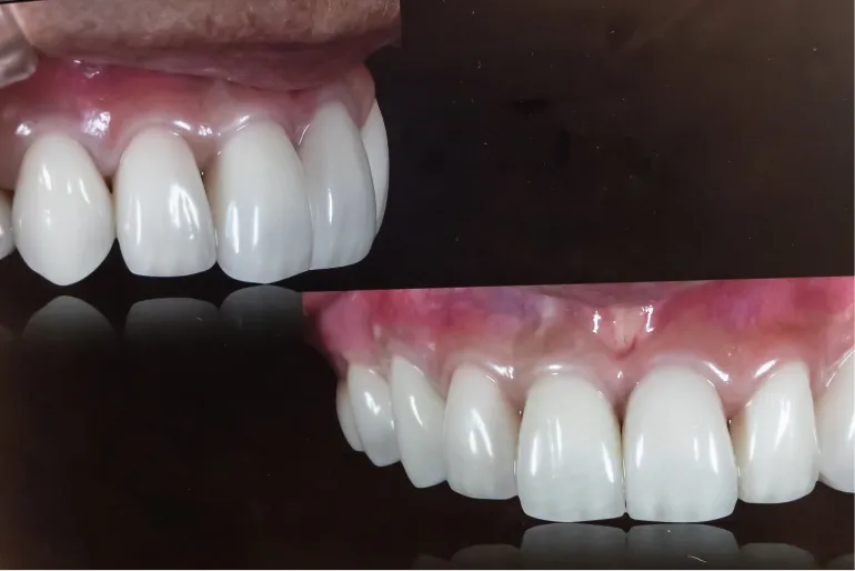 治療後の歯が長持するために