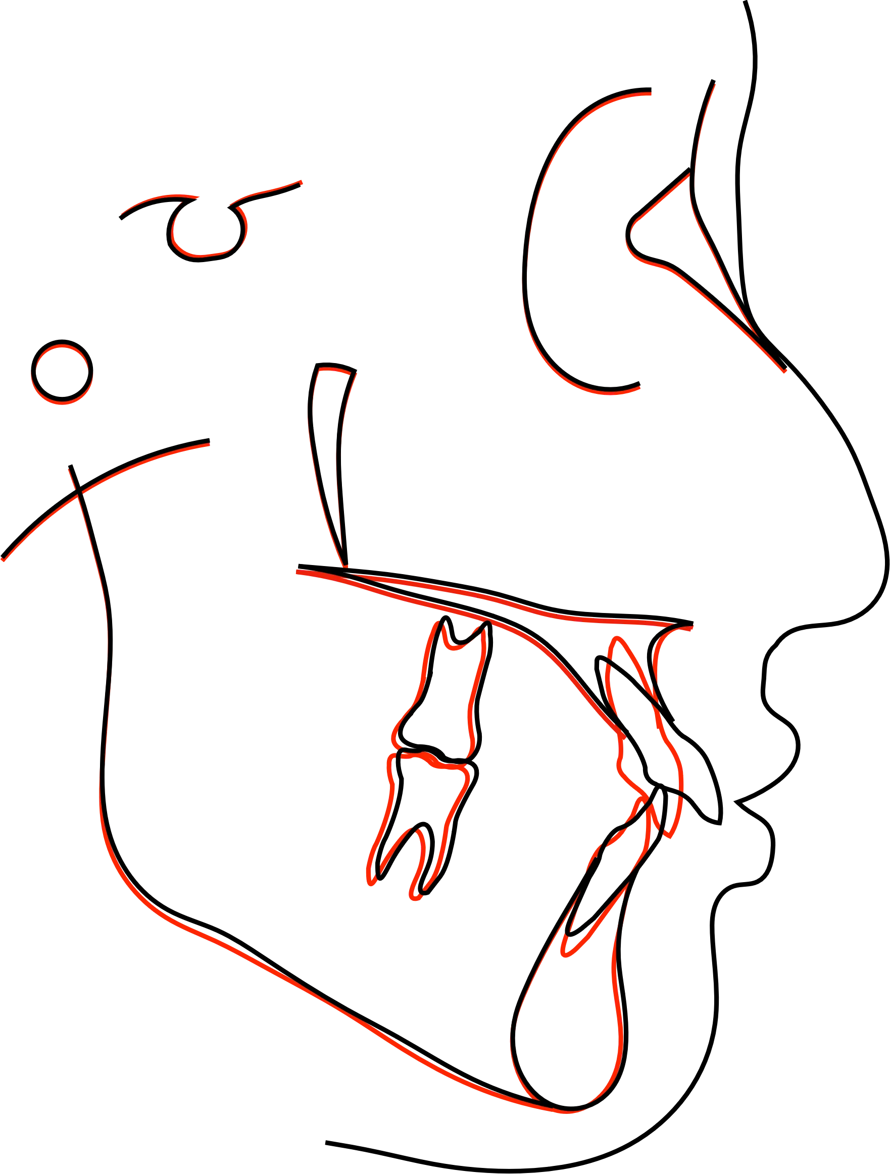 術前術後の重ね合わせ