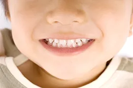 第Ⅰ期・第Ⅱ期の小児矯正に対応しています